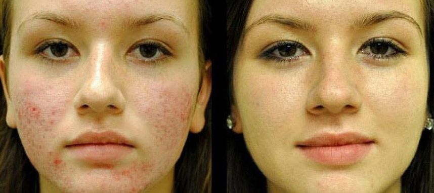 Dưỡng da với dầu dừa sai cách sẽ hại chết làn da - Hoa Thien Thao Cosmetics