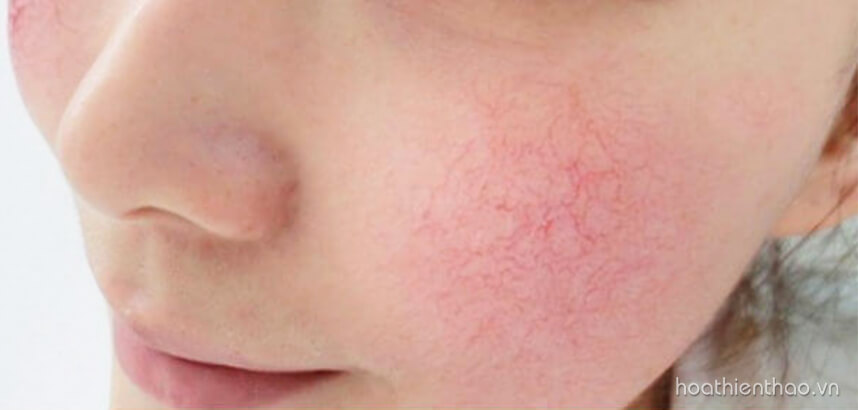 Hậu quả tác hại của việc dùng kem không rõ nguồn gốc xuất xứ - HoaThienThao