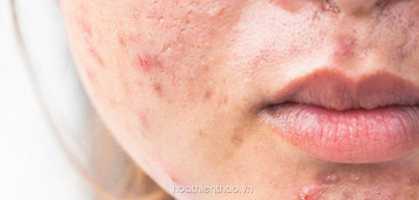 Hậu quả tác hại của việc dùng kem không rõ nguồn gốc xuất xứ - HoaThienThao