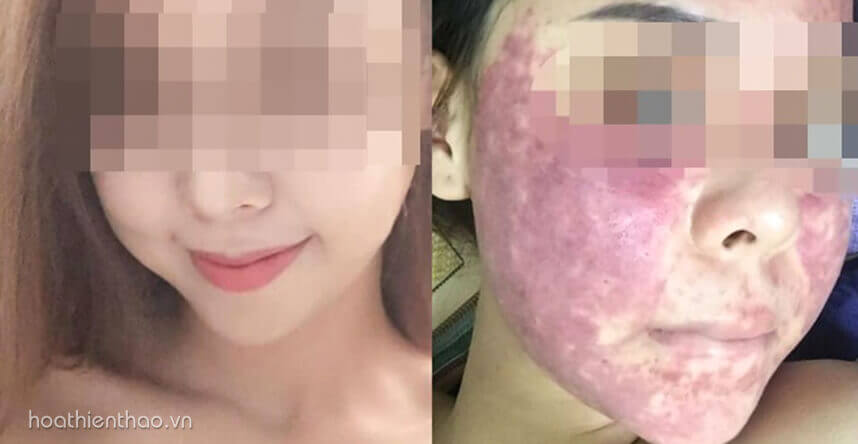 Hình ảnh da sau khi dùng kem trộn - HoaThienThao