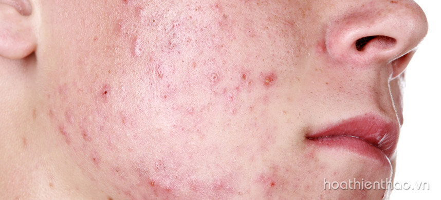 Jojoba là gì - Tinh dầu jojoba có tác dụng gì trong làm đẹp - Hoa Thiên Thảo