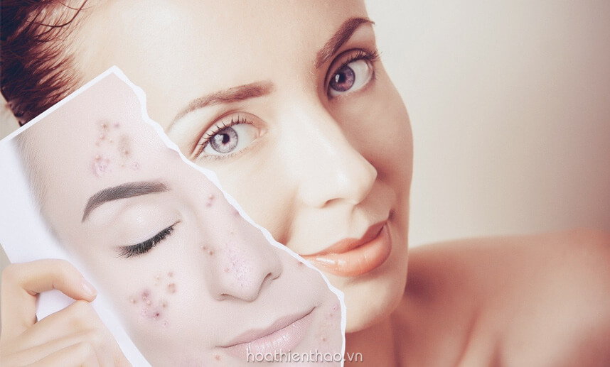 Kem Replay có dùng được cho da mụn như lời đồn? Hoa Thiên Thảo