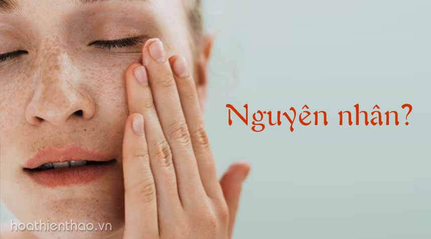 Kem trị nám số 1 Nhật Bản - HoaThienThao