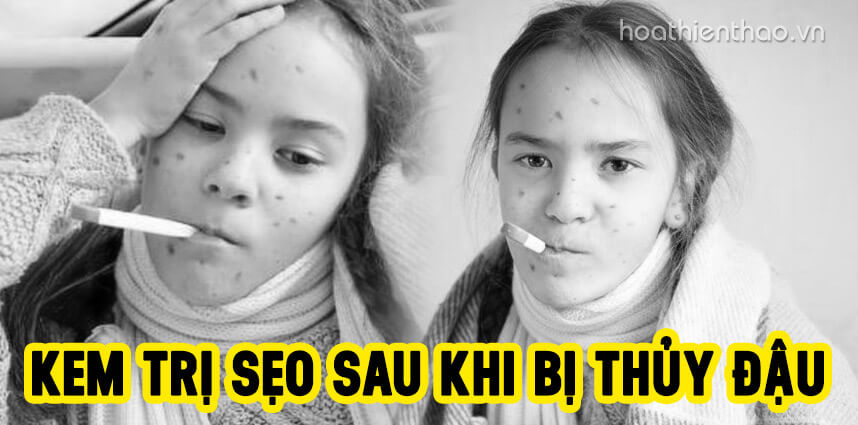 Bật mí kem trị sẹo sau khi bị thủy đậu tốt nhất - Hoa Thiên Thảo