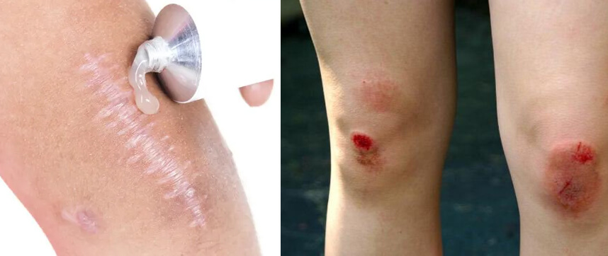 Kem trị sẹo té xe hiệu quả cần có những gì - Hoa Thiên Thảo