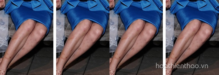 Kem trị sẹo thâm ở chân tốt nhất hiện nay - Hoa Thiên Thảo