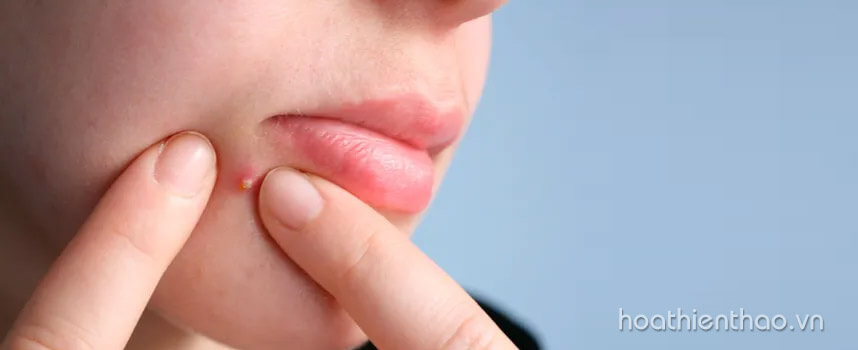 mới nặn mụn bọc xong nên làm gì - Hoa Thiên Thảo