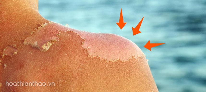 cách chống nắng mùa hè - Hoa Thiên Thảo