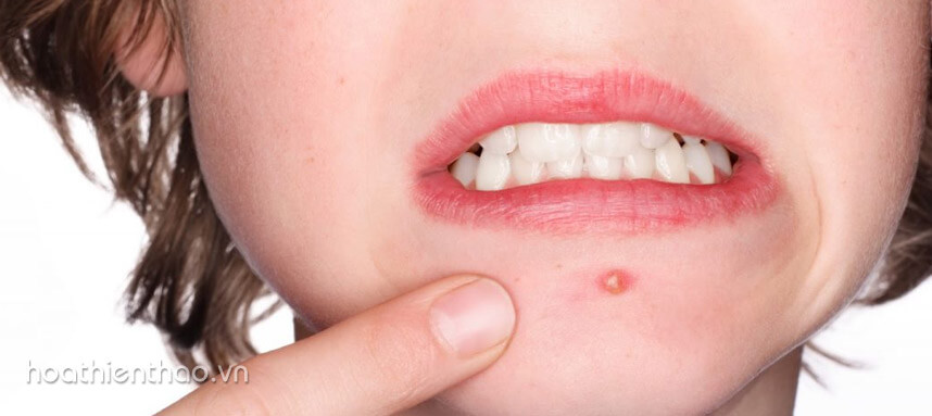 Mụn mọc ở mép miệng - Nguyên nhân và cách khắc phục - Hoa Thiên Thảo