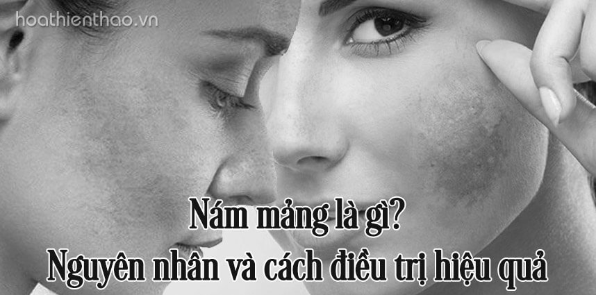 Nám mảng là gì Nguyên nhân và cách điều trị hiệu quả - Hoa Thiên Thảo