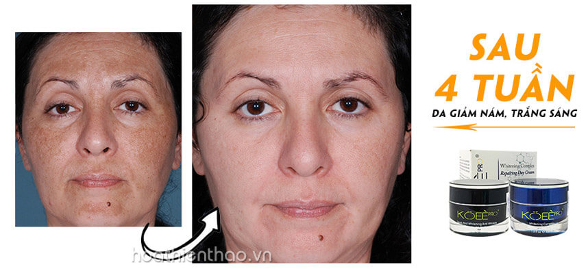 Nám mảng là gì Nguyên nhân và cách điều trị hiệu quả - Hoa Thiên Thảo