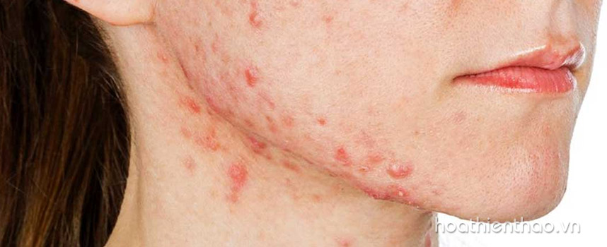 Bật mí những cách trị dị ứng da mặt nhanh nhất - Hoa Thiên Thảo