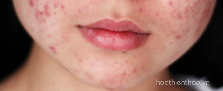 Phụ nữ có thai dùng kem trị mụn được không - Hoa Thiên Thảo