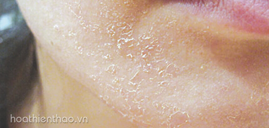 Phục hồi da mặt sau khi dùng kem trộn - HoaThienThao