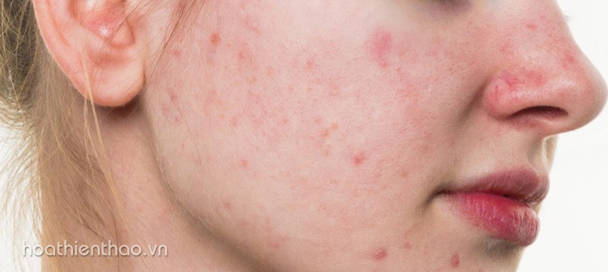 Review kem kiểm soát nhờn Perfect chi tiết - Hoa Thiên Thảo