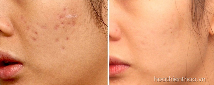 Review kem trị sẹo Kelo Cote chi tiết cho bạn gái - Hoa Thiên Thảo