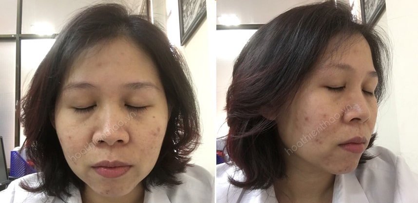 Review mặt nạ dịu da MartiDerm cho da nhờn mụn - HoaThienThao