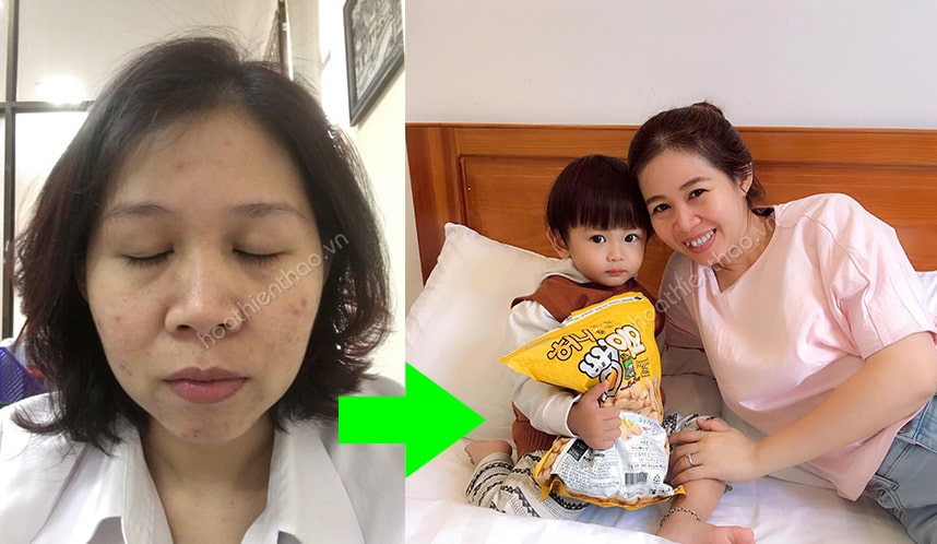 Review mặt nạ dịu da MartiDerm cho da nhờn mụn - HoaThienThao