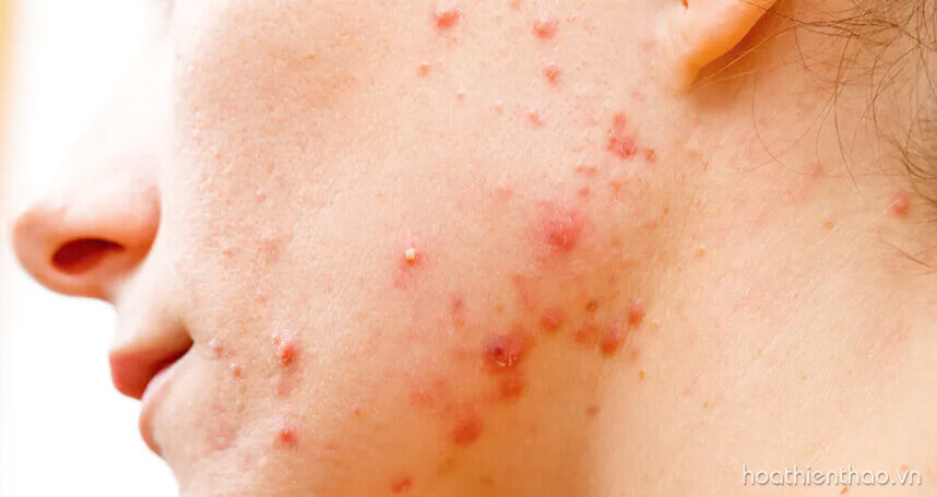 Review viên uống trị mụn Sakura Acne Pill - HoaThienThao