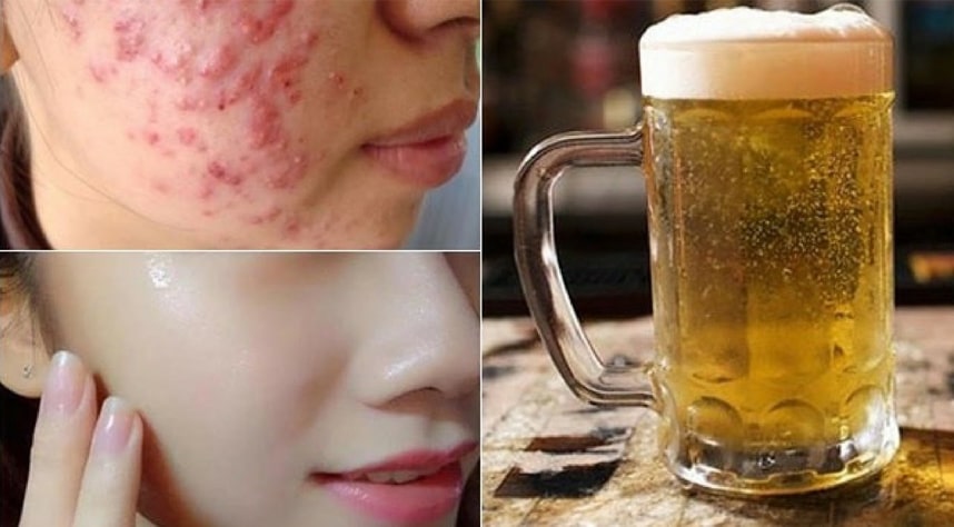 Rửa mặt bằng bia có tốt như lời đồn? - HoaThienThao