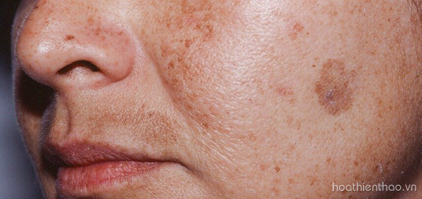 Serum trị nám hiệu quả - HoaThienThao