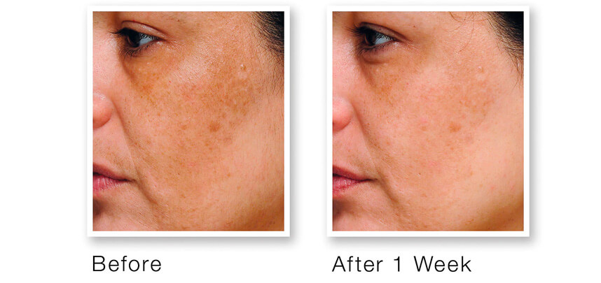 Serum trị nám Murad có tốt không? HoaThienThao
