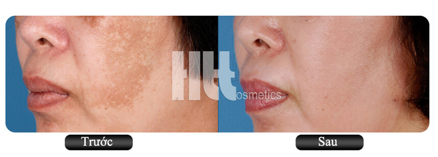 So sánh viên uống trị nám Perfect White và Murad - HoaThienThao