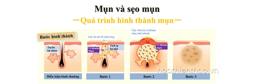 Bạn có biết tại sao trị mụn hoài không hết - Hoa Thiên Thảo