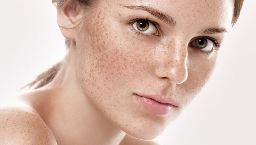 Trị nám bằng tia laser có hiệu quả không - HoaThienThao