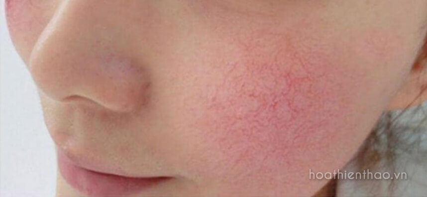Các bước phục hồi da bị bào mòn nhanh chóng