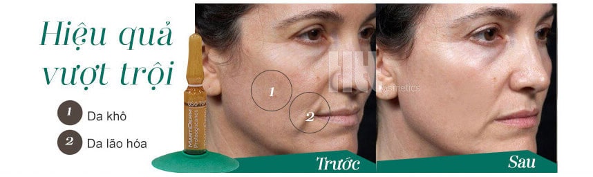 Hiệu quả vượt trội trước và sau khi sử dụng MartiDerm ProteoGlicanos Ampoules