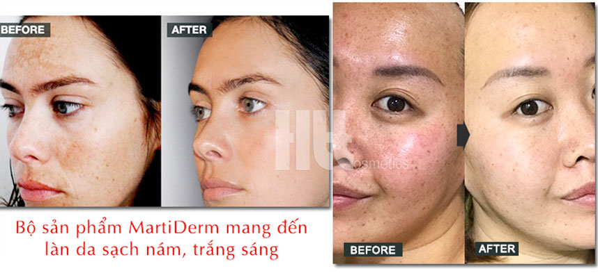 Hiệu quả trị nám dưỡng trắng da của bộ kem Martiderm