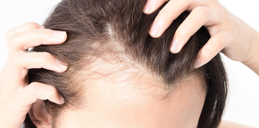 Mái tóc bị thưa mỏng nhanh làm mình hốt hoảng