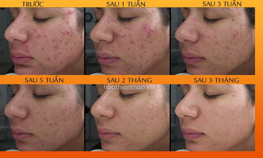 Mụn nang lông – Những điều bạn không nên bỏ qua