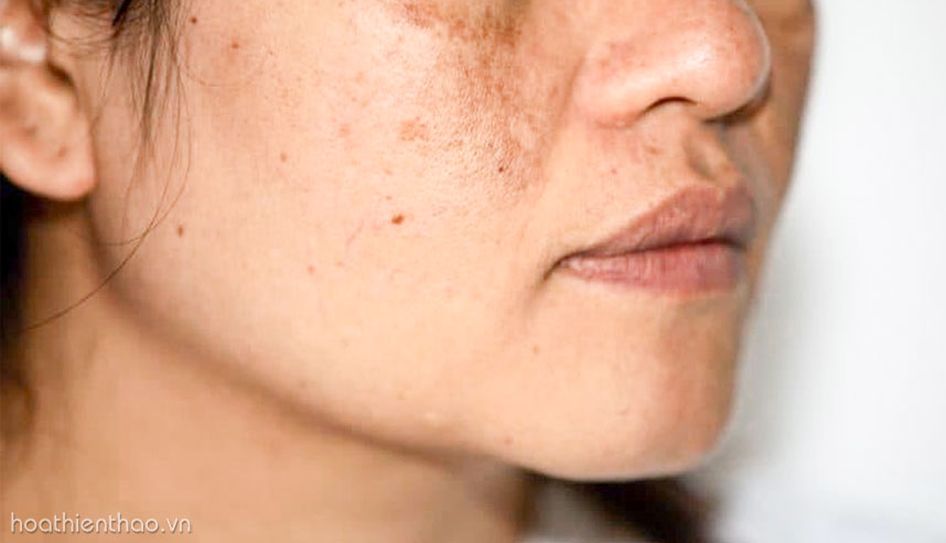 Nám có ảnh hưởng gì đến làn da?