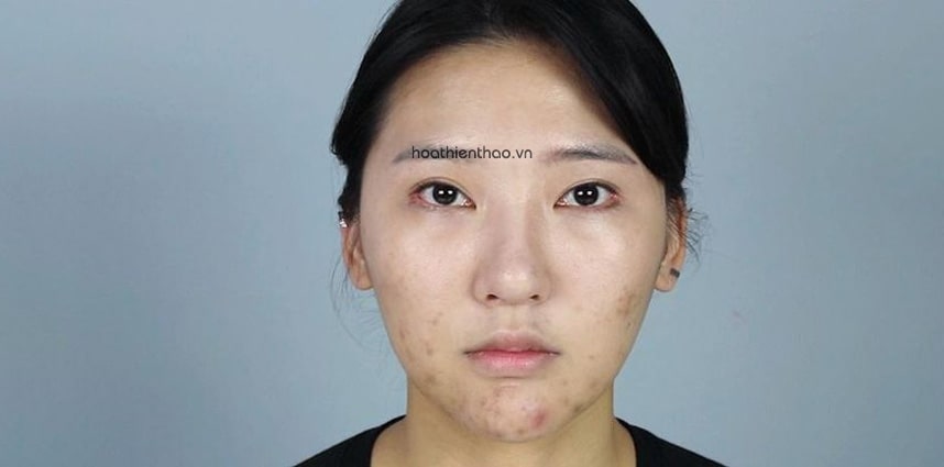 Lý do khiến thâm mụn xuất hiện không hết