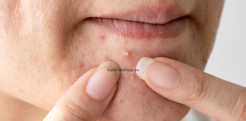 Từ bỏ thói quen nặn mụn quá sớm