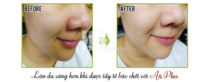 Gel tẩy tế bào chết da mặt A&Plus Deep Peeling A015
