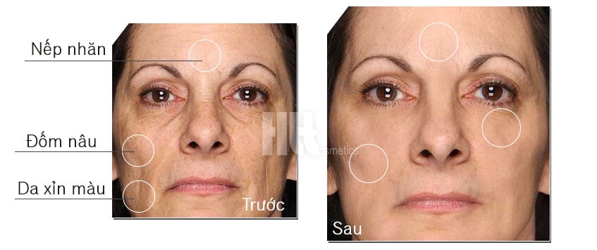Kem trắng da trị nám ngày và đêm A&Plus B006
