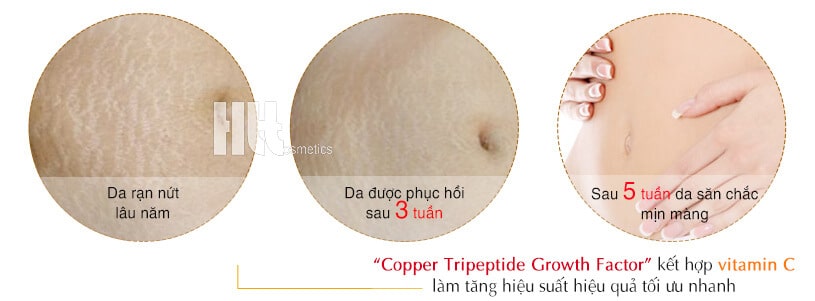 Serum giảm rạn da sẹo thâm Is Clinical Super Serum Advance chính hãng tại Hoa Thiên Thảo