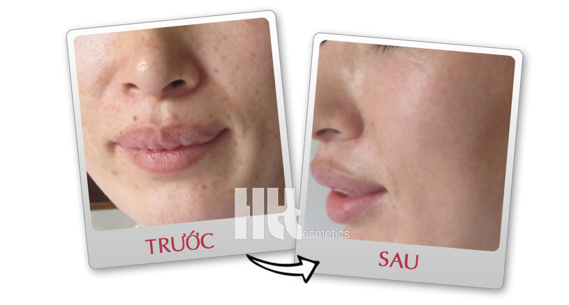 Serum trị nám A&Plus L-Ascorbic Acid A019