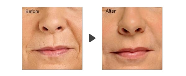 Bộ hỗ trợ điều trị lão hóa toàn diện cấp độ phân tử Mesoestetic Radiance DNA Professional Treatment