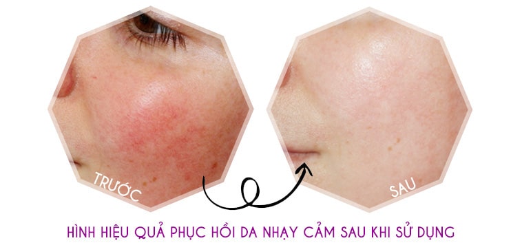 Kem dưỡng trắng dành cho da nhạy cảm Sakura - phục hồi da chắc khỏe, trắng mịn tự nhiên