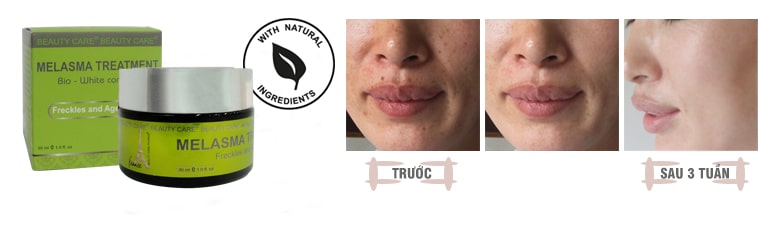 Kem trắng da trị nám Melasma Treatment Beauty Care