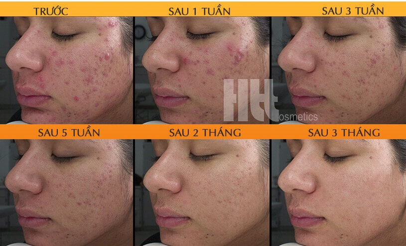 Bộ sản phẩm trị mụn nặng iS Clinical - Hoa Thien Thao Cosmetics