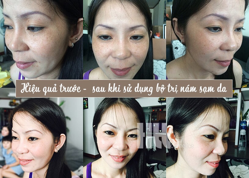 Bộ sản phẩm trị nám sạm da Mesoestetic Energy C - Hoa Thien Thao Cosmetics