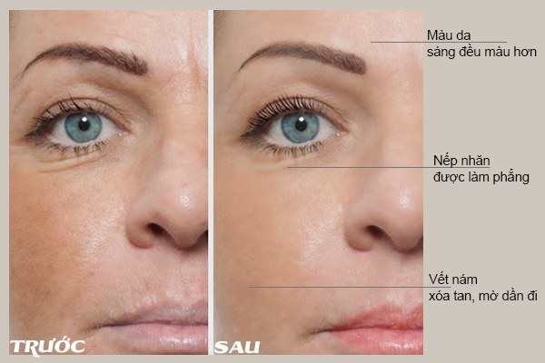 Trước và sau khi sử dụng Mesoestetic Energy C Professional Treatment