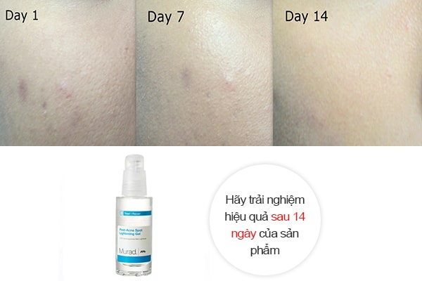 Hiệu quả gel giảm thâm mụn Murad có thể nhanh chậm tùy theo thể trạng và cơ địa