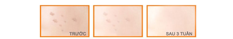 Công dụng kem trị nám Melasma Treatment Beauty Care 1