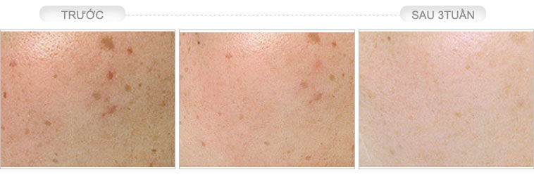 Công dụng kem trị nám Melasma Treatment Beauty Care 2